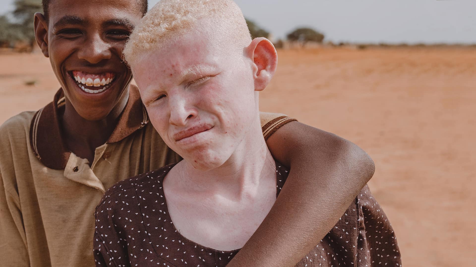 El albinismo en África.